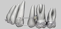 TAD  - временная скелетная опора в ортодонтии