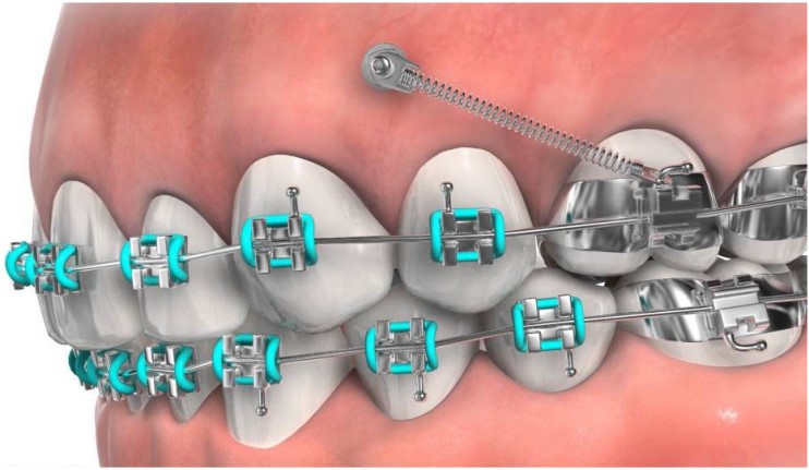TAD  - временная скелетная опора в ортодонтии